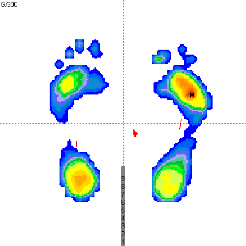 Empreinte podomètrique mettant en évidence une hyperpression sous l'avant du pied droit
