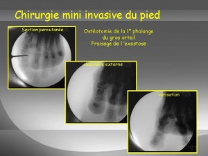 Chirurgie mini invasive du pied