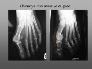 Chirurgie mini invasive du pied