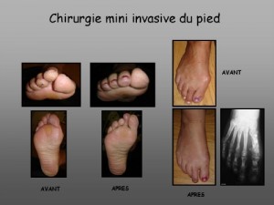 Chirurgie mini invasive du pied