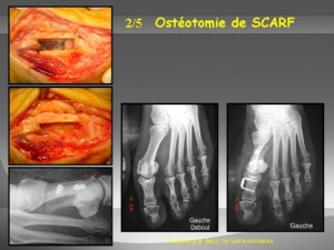 Osteotomie de SCARF