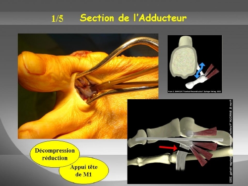 Section du tendon adducteur