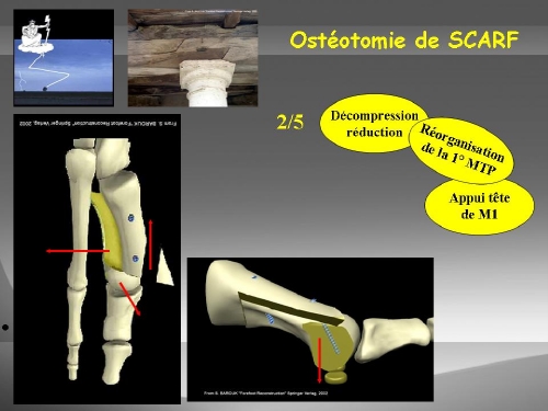 L’ostéotomie métatarsienne de scarf