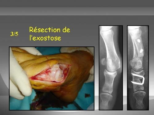 Résection de l’exostose (la bosse)