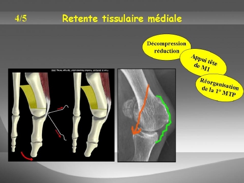 Remise en tension de la capsule articulaire distendue