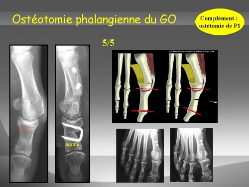 L’ostéotomie de réaxation du gros orteil