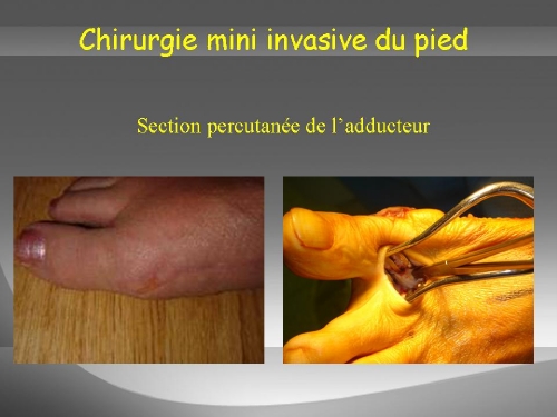 Section du tendon adducteur