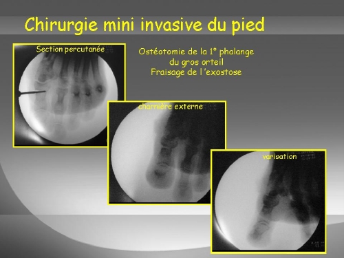 Ostéotomie du gros orteil