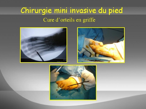 Chirurgie des orteils en griffe