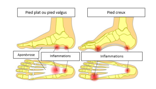 Epine calcanéenne ou aponévrosites plantaires - Cabinet de ...
