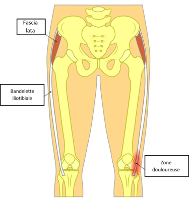 TFL OU SYNDROME DE L'ESSUI GLACE – Douleur genou - Cabinet de ...