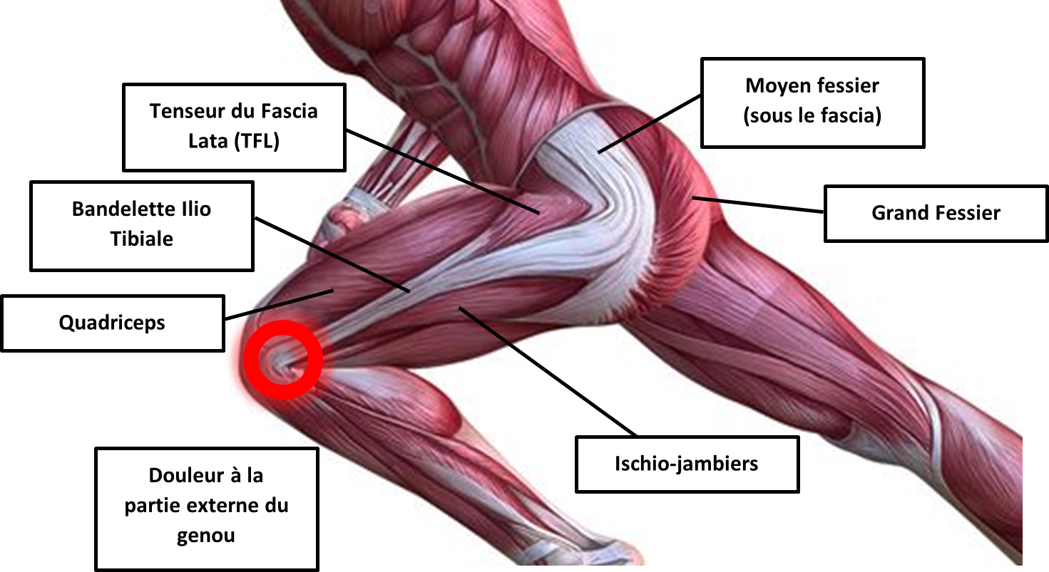 TFL OU SYNDROME DE L’ESSUI GLACE Douleur genou de podologie du sport à Sèvres
